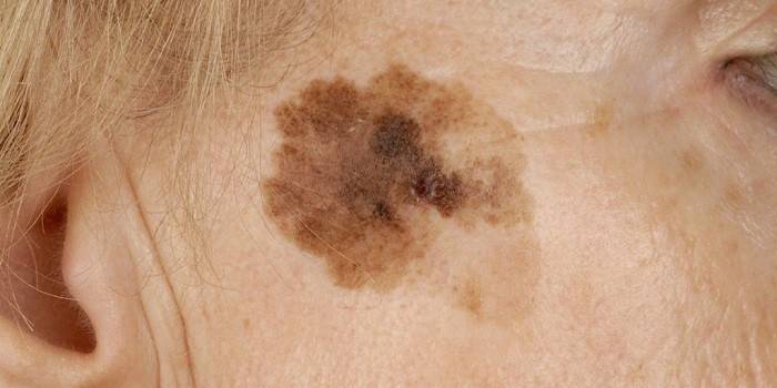 Lentigo sur le visage