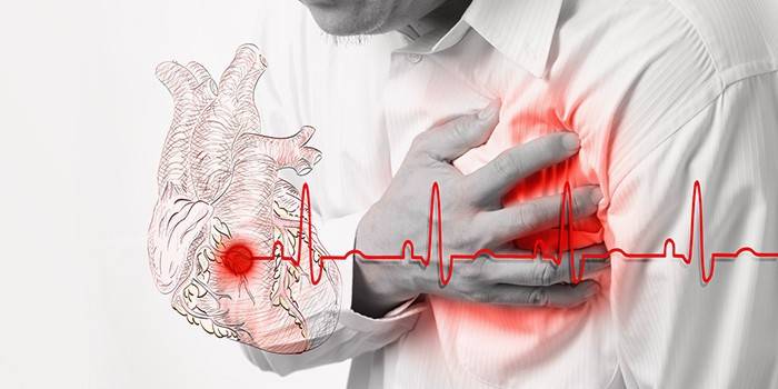 Infarctus du myocarde