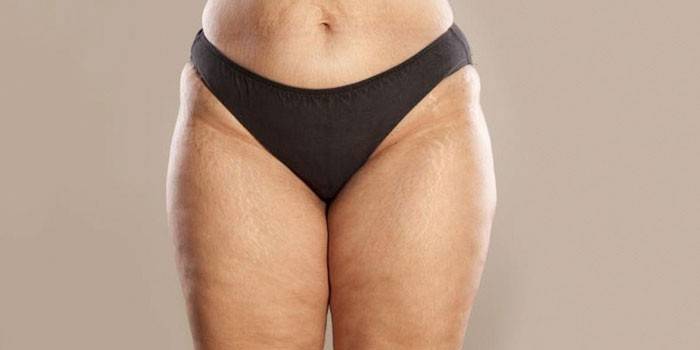 Vergetures sur les jambes