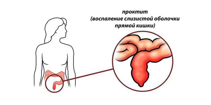 Đề án viêm ruột