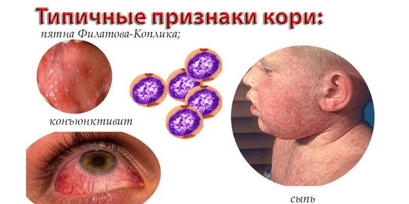 Знакови оспица код деце