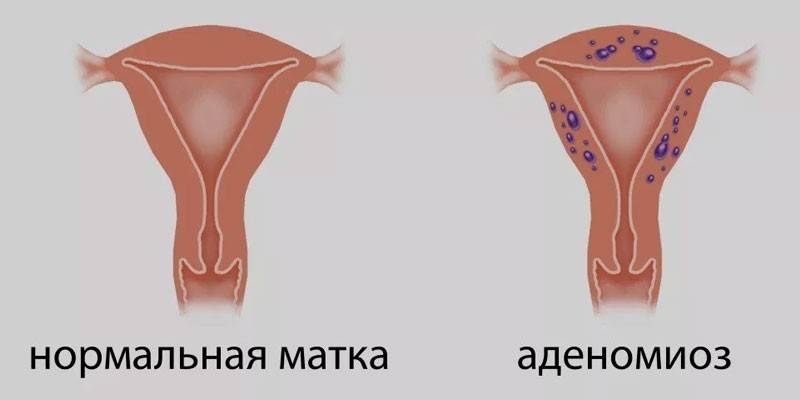 Μήτρα για ασθένεια