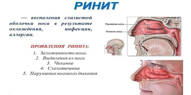 Alerginis rinitas