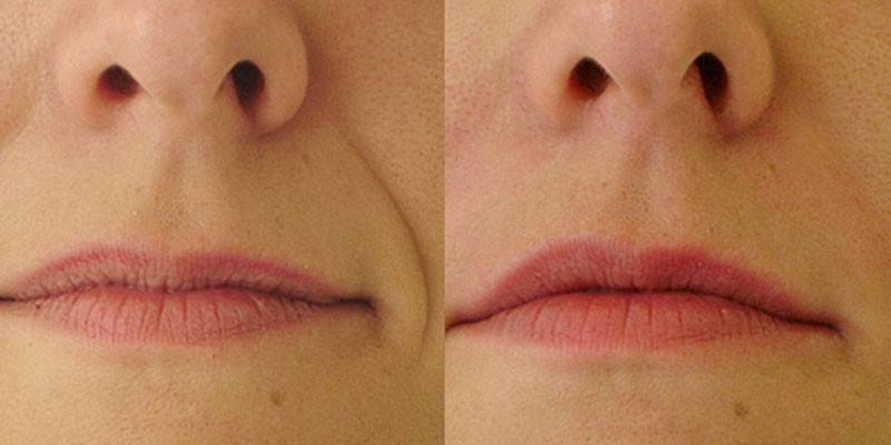 Photos before and after correction