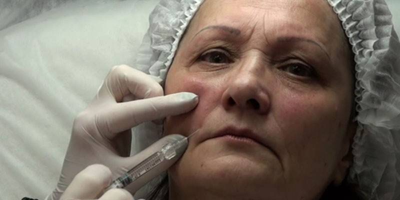 Woman injected filler