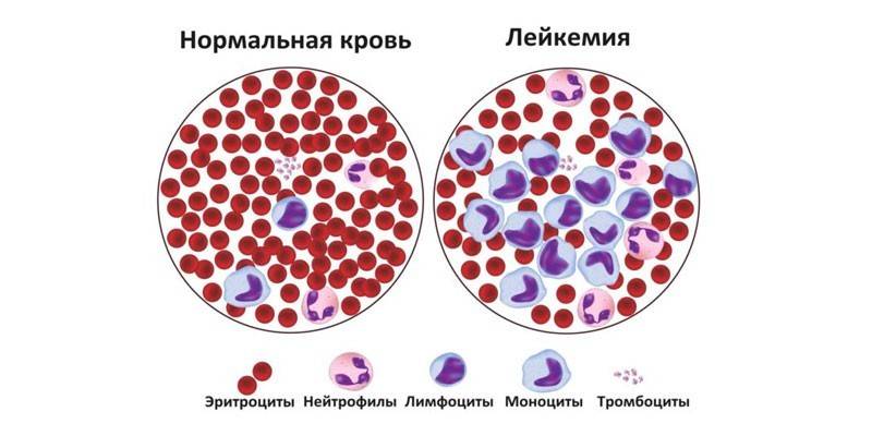 Normalus kraujas ir leukemija