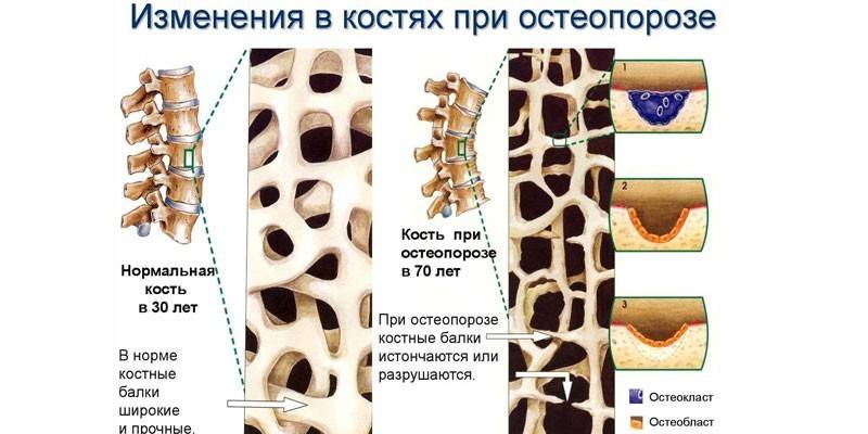 Luun muutokset osteoporoosissa