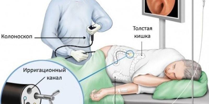 Kolonoskopijas procedūra