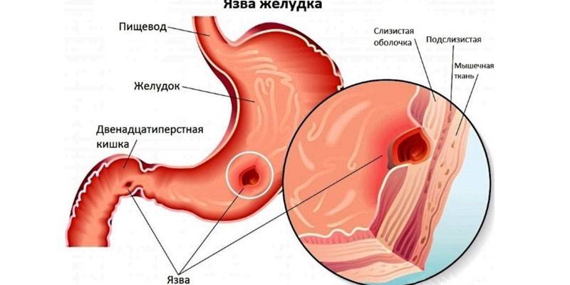 Skrandžio ir dvylikapirštės žarnos opa
