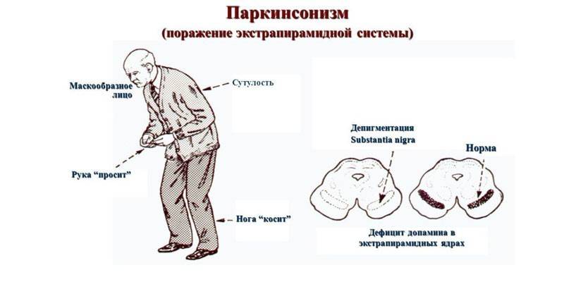 Parkinsonizmas