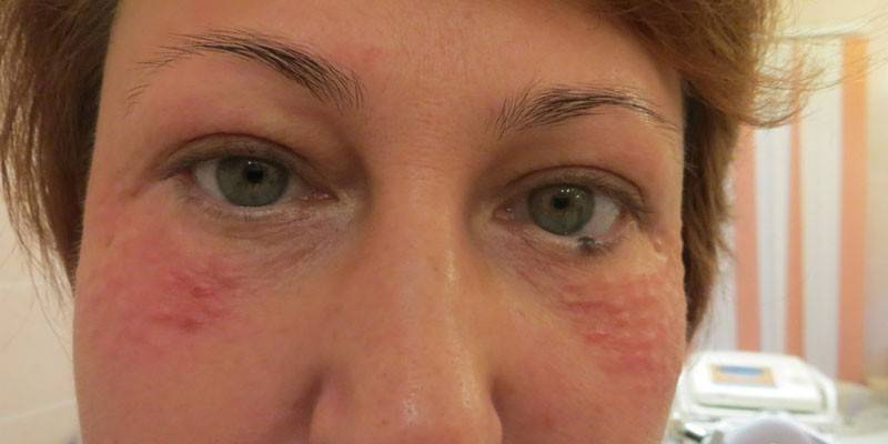 Ansigt efter biorevitalisering