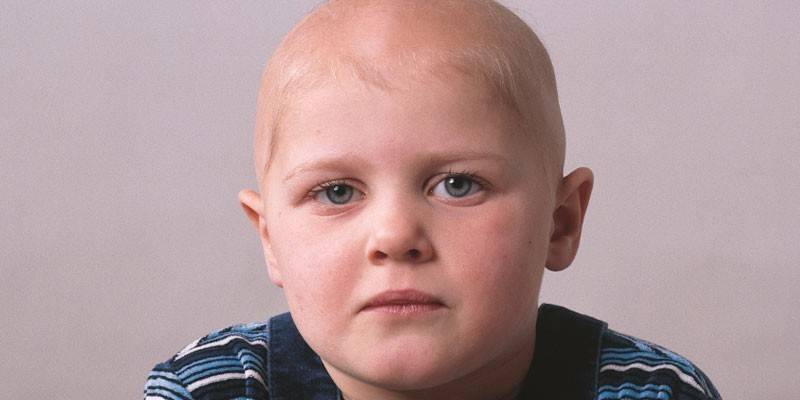 Bendra vaikų alopecija
