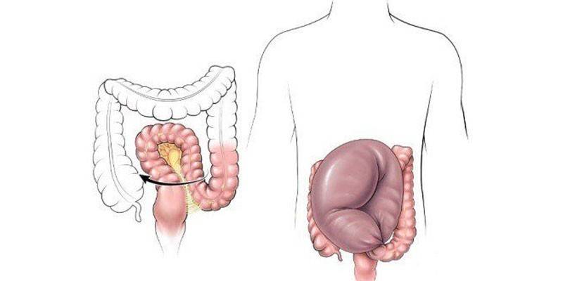 Dolichosigma đường ruột