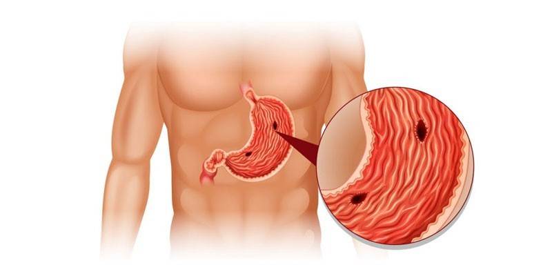 Gastroduodénite de forme érosive