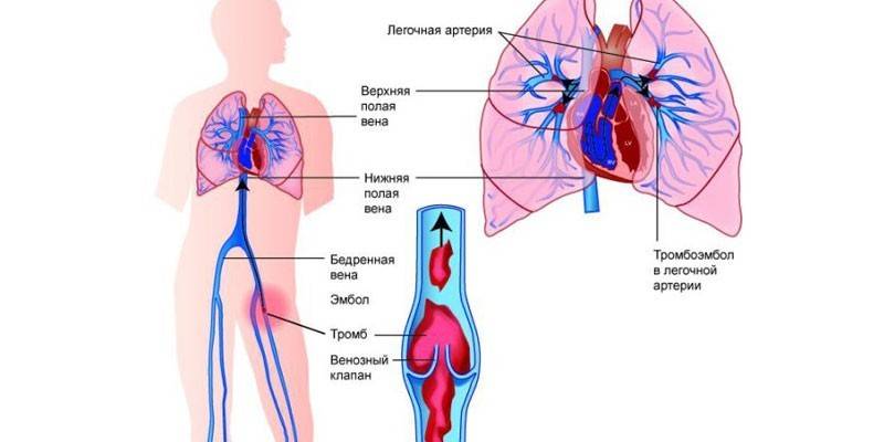 Tromboembolismo Pulmonar
