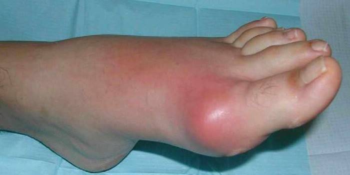 La manifestation de l'arthrite goutteuse sur la jambe