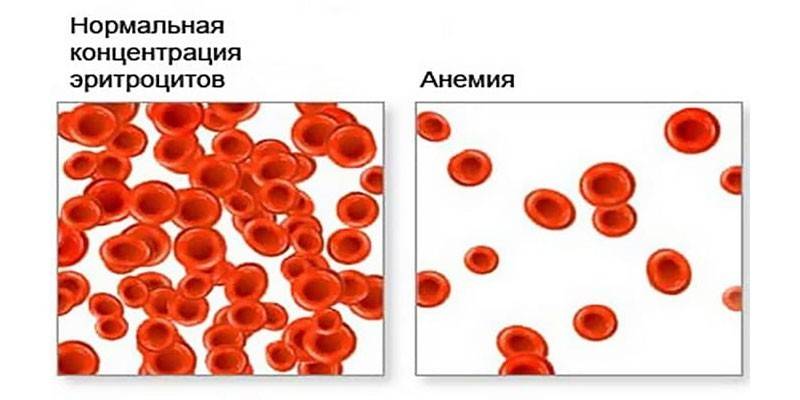 Anemia hipercrómica