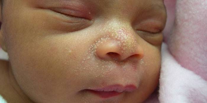Points blancs sur le visage d'un nouveau-né