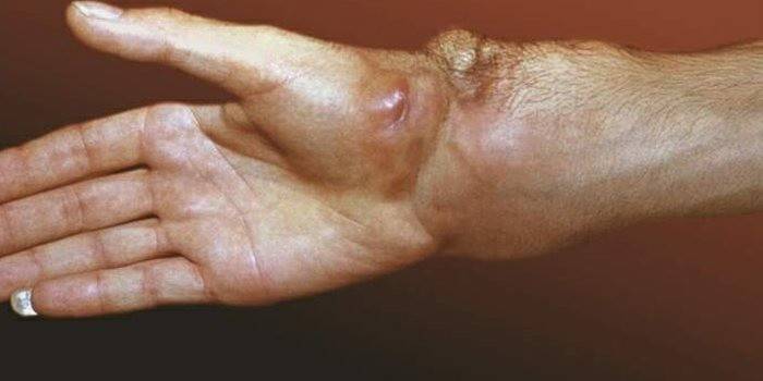 Epithelioid sarcoma slimība