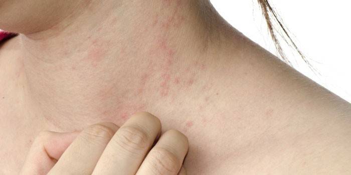Eruzioni cutanee sul collo della donna