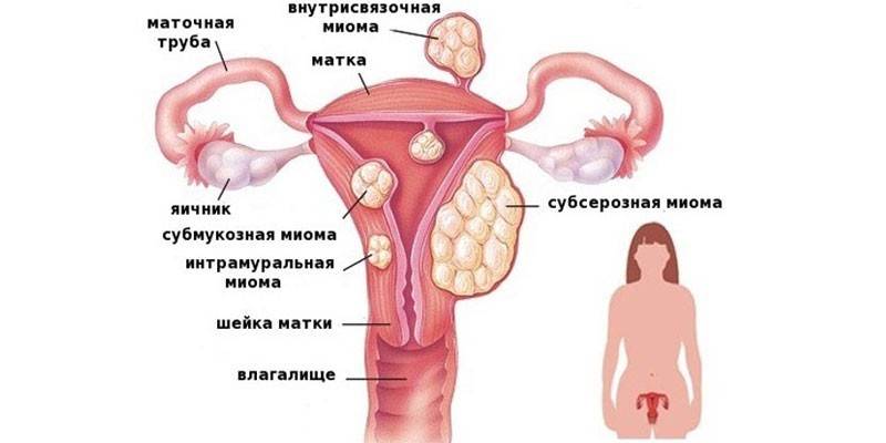 Τύποι ινομυωμάτων