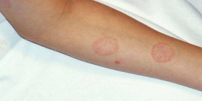 Biểu hiện của microsporia trên da người