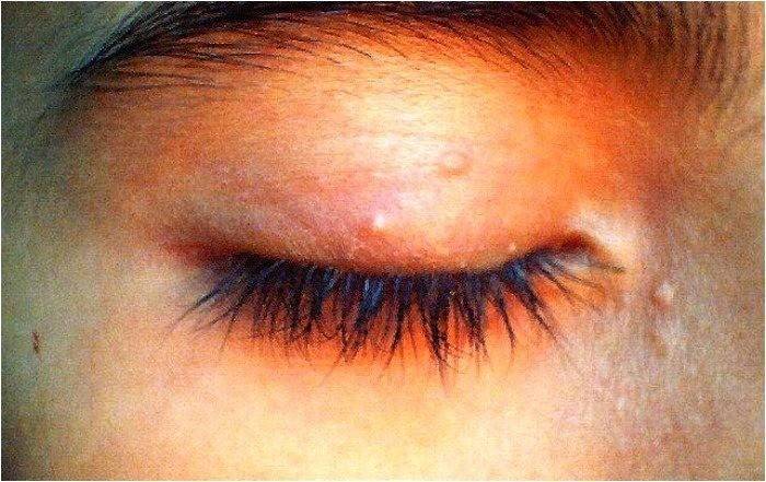 Η εκδήλωση του molluscum contagiosum