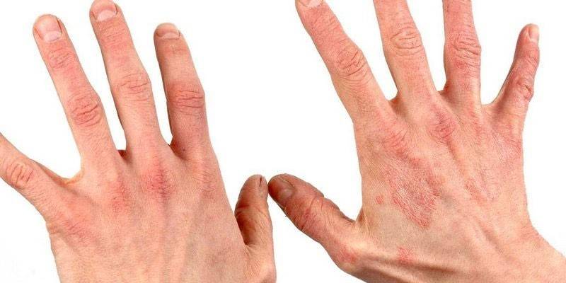 Dermatite nas mãos