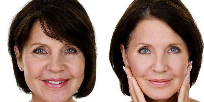 Mujer antes y después de botox para rostro.