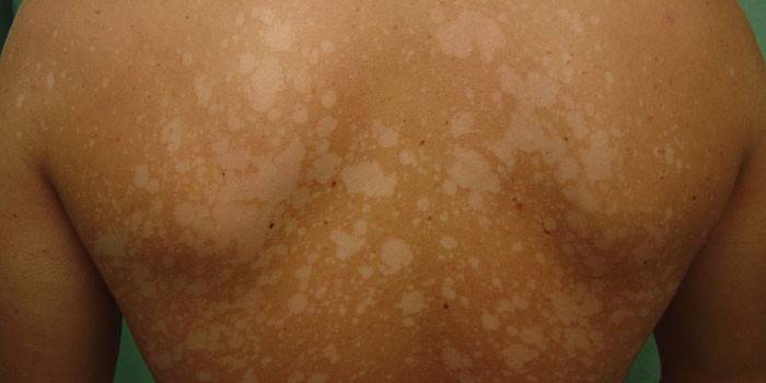 Keratomycosis versicolor