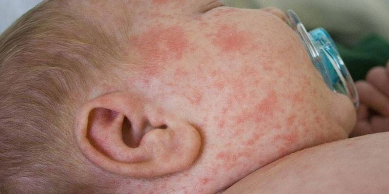 Irritation infantile