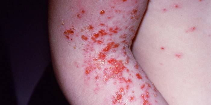 Des éruptions cutanées avec la gale sur la peau d'un enfant