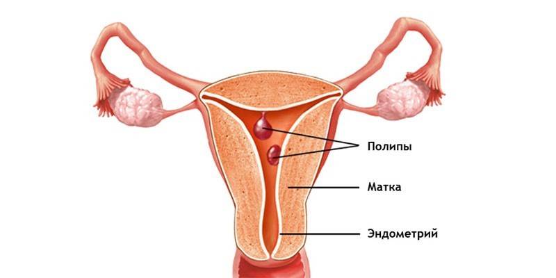 Σχέδιο εντοπισμού Polyp