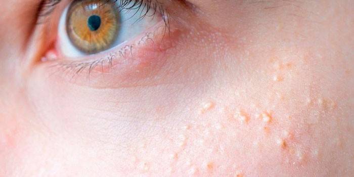 Points blancs sur le visage d’une personne