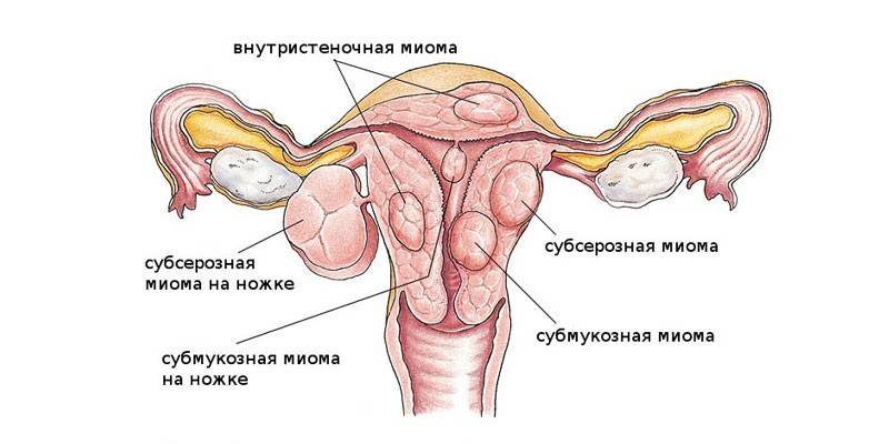 Fibroīdu klasifikācija pēc to atrašanās vietas attiecībā pret dzemdi