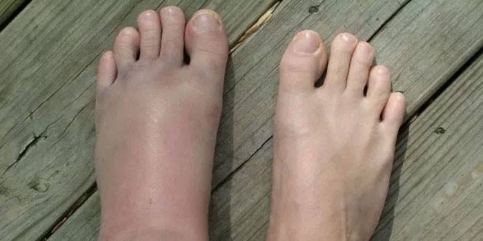 Ligamentita piciorului