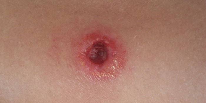 Fistule sur la peau