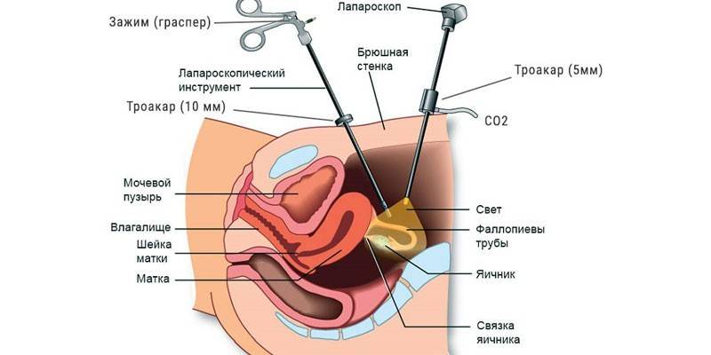 Dzemdes fibroīdu laparoskopija