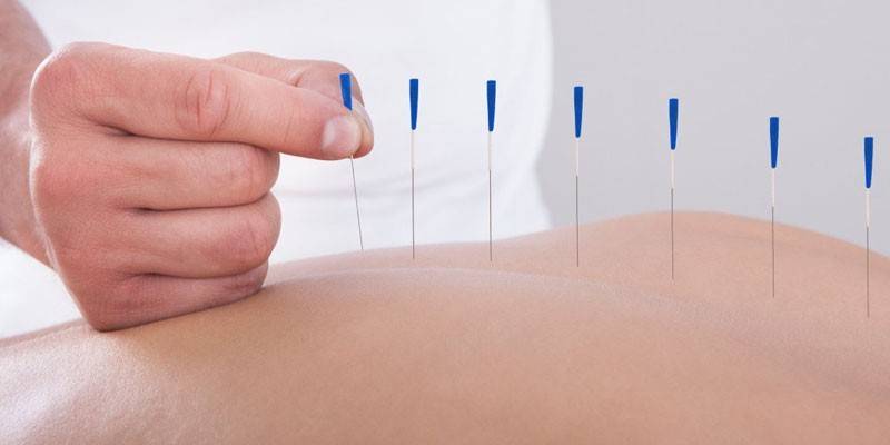 Procédure d'acupuncture