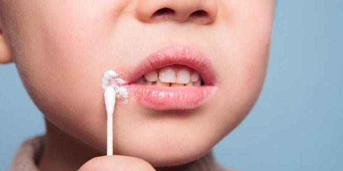 Rhume sur les lèvres d'un enfant