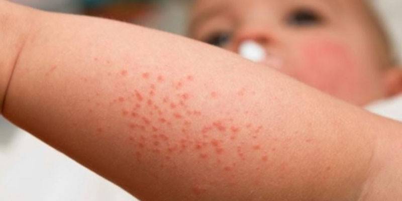 Chaleur épineuse papuleuse