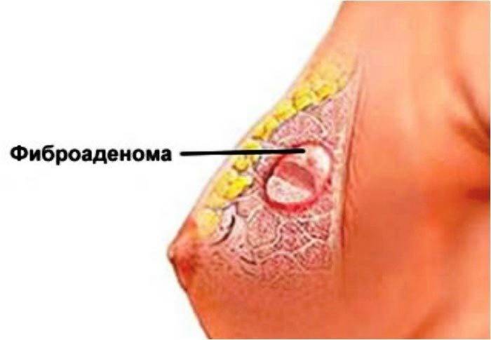 Fibroadenomtumor