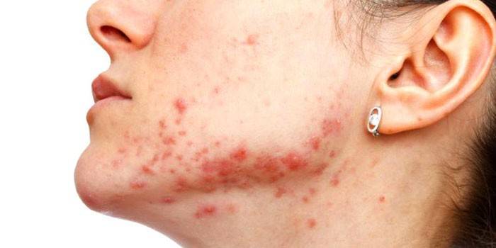 Staphylococcus in un adulto