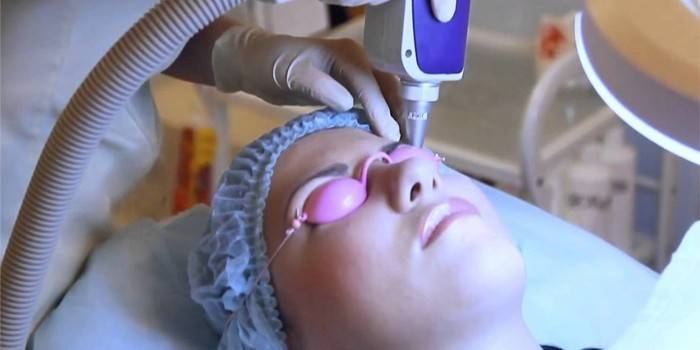 Correction des sourcils au laser