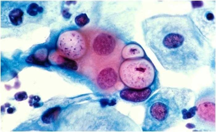 Chlamydia trachomatis