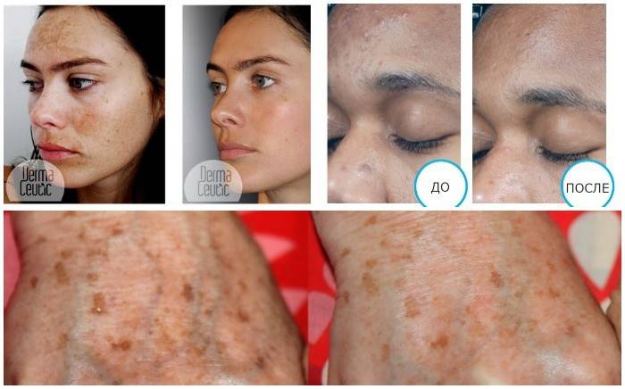 Kết quả sau khi sử dụng sản phẩm làm trắng