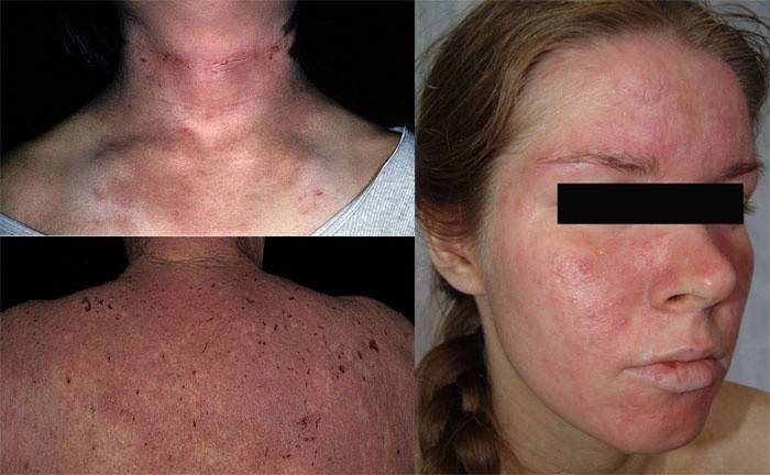 Foci di dermatite atopica