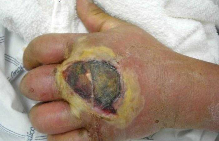 Attacco dell'infezione da stafilococco alla dermatite