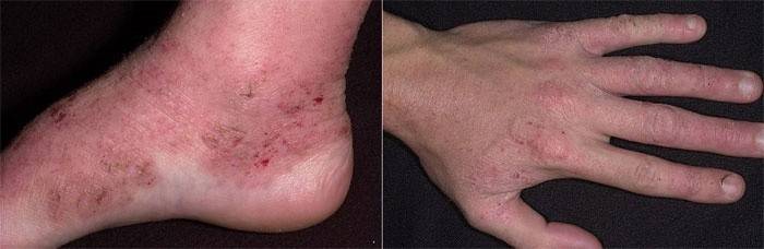 Forma atopica