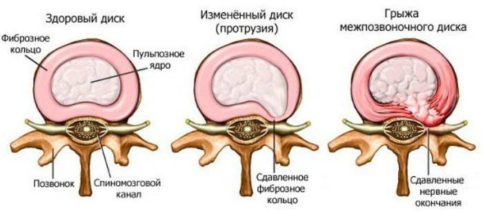 ขั้นตอนของการ Osteochondrosis